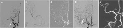 Endovascular Recanalization of Non-acute Symptomatic Middle Cerebral Artery Total Occlusion and Its Short-Term Outcomes